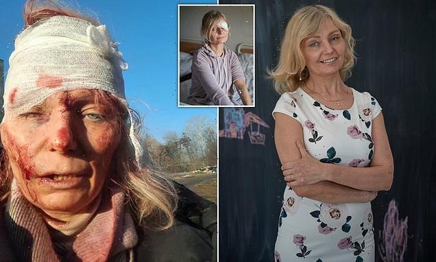 Ukrainian woman with bandaged eye now running art classes