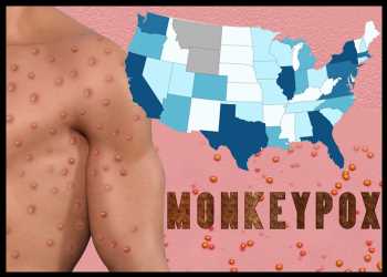 US Declares Monkeypox A Public Health Emergency