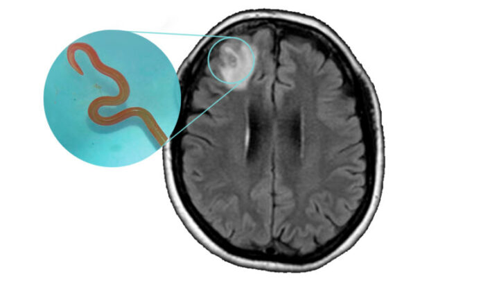 1.5 billion humans share their bodies with worms. But how does one get into a brain?