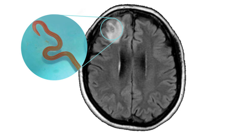 1.5 billion humans share their bodies with worms. But how does one get into a brain?